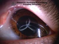 Sutural Cataract